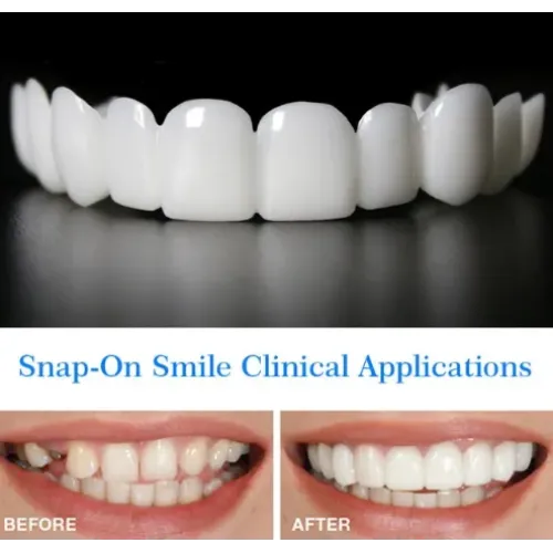 Накладні вініри для зубів Snap on smile з кейсом знімні - фото 6
