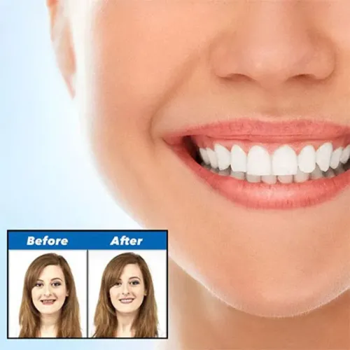 Вініри для зубів Perfect smile veneers. Голлівудська усмішка - фото 5