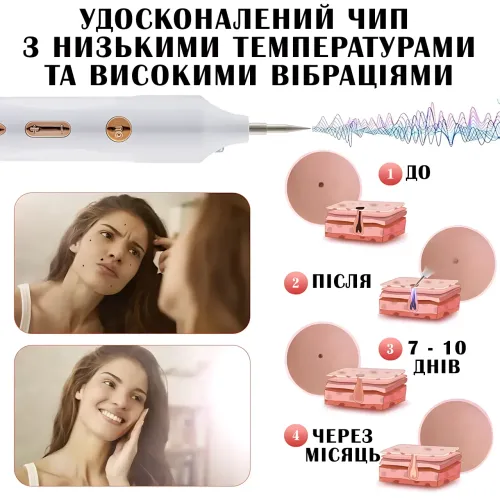 Портативный косметический плазменный коагулятор Mole Point – удаление папиллом, бородавок, пигментных пятен - фото 6